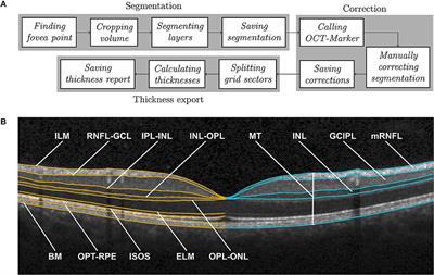 Normative Data and Minimally Detectable Change for Inner Retinal Layer Thicknesses Using a Semi-automated OCT Image Segmentation Pipeline